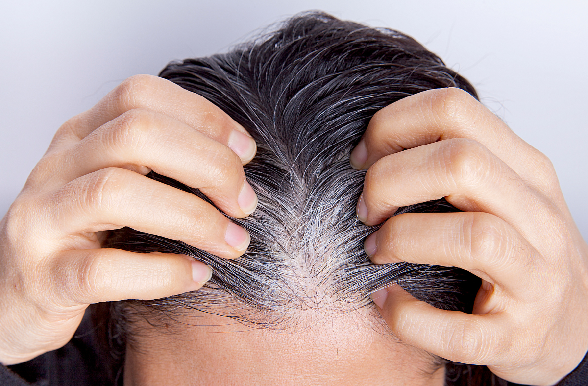 Female Pattern Baldness Causes And Solutions Eldorado Hair