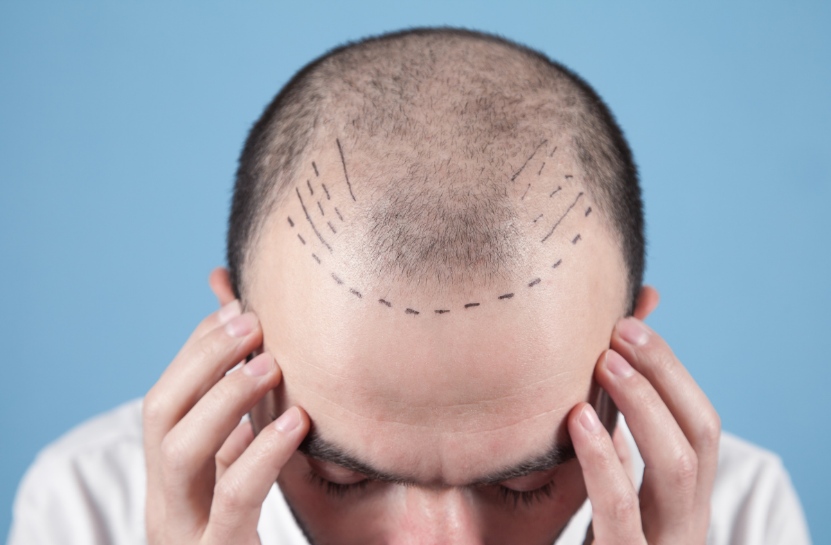 Read more about the article What You Need to Know About Hair Transplants and Hair Loss