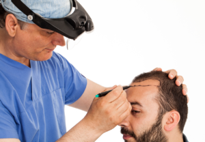 Image of a hair transplant doctor performing a hair transplant 