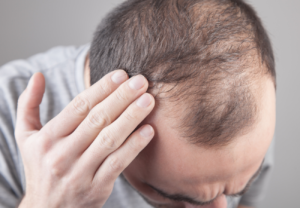 Read more about the article When Should You Call a Hair Loss Professional?