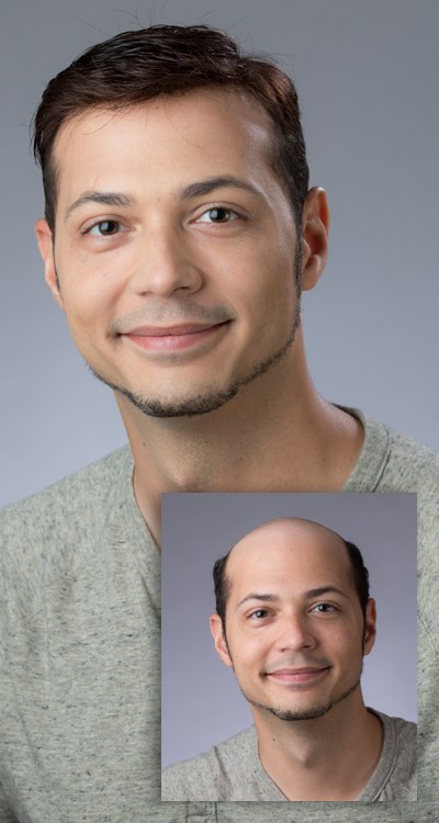 Man with full head of hair after hair loss replacement