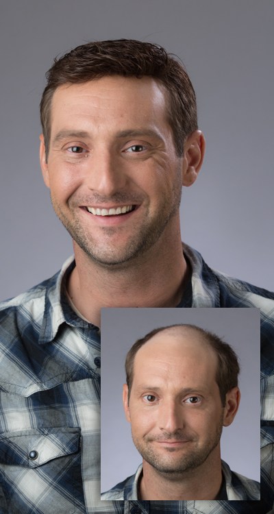 Excited man before and after hair regrowth system