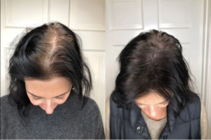 Read more about the article Micropigmentation (Scalp tattoos)