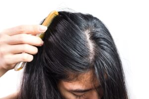 A woman combing her hair back to uncover her scalp.