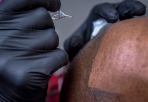 Read more about the article Scalp Micropigmentation (SMP) as a Hair Loss Solution