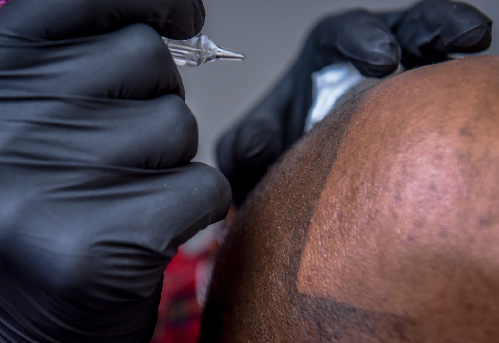 You are currently viewing Scalp Micropigmentation (SMP) as a Hair Loss Solution