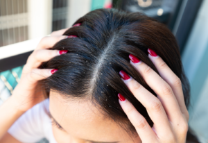 Read more about the article Remedies for Dandruff and Itchy Scalp