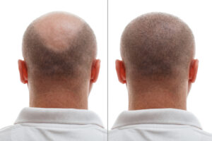 Image of a hair transplant