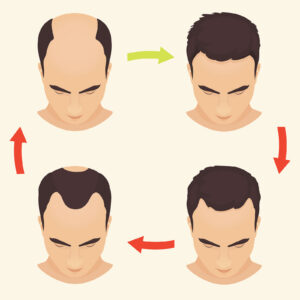 Hair transplant chart